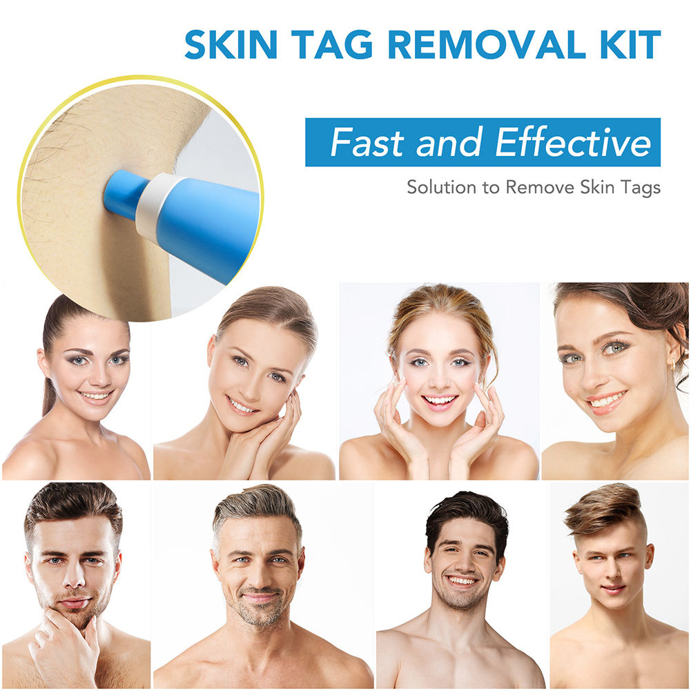 2-IN-1 Auto Skin Tag Removal K – Home Improvement Kit recenzja i cena
